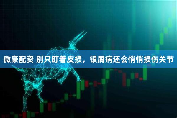 微豪配资 别只盯着皮损，银屑病还会悄悄损伤关节